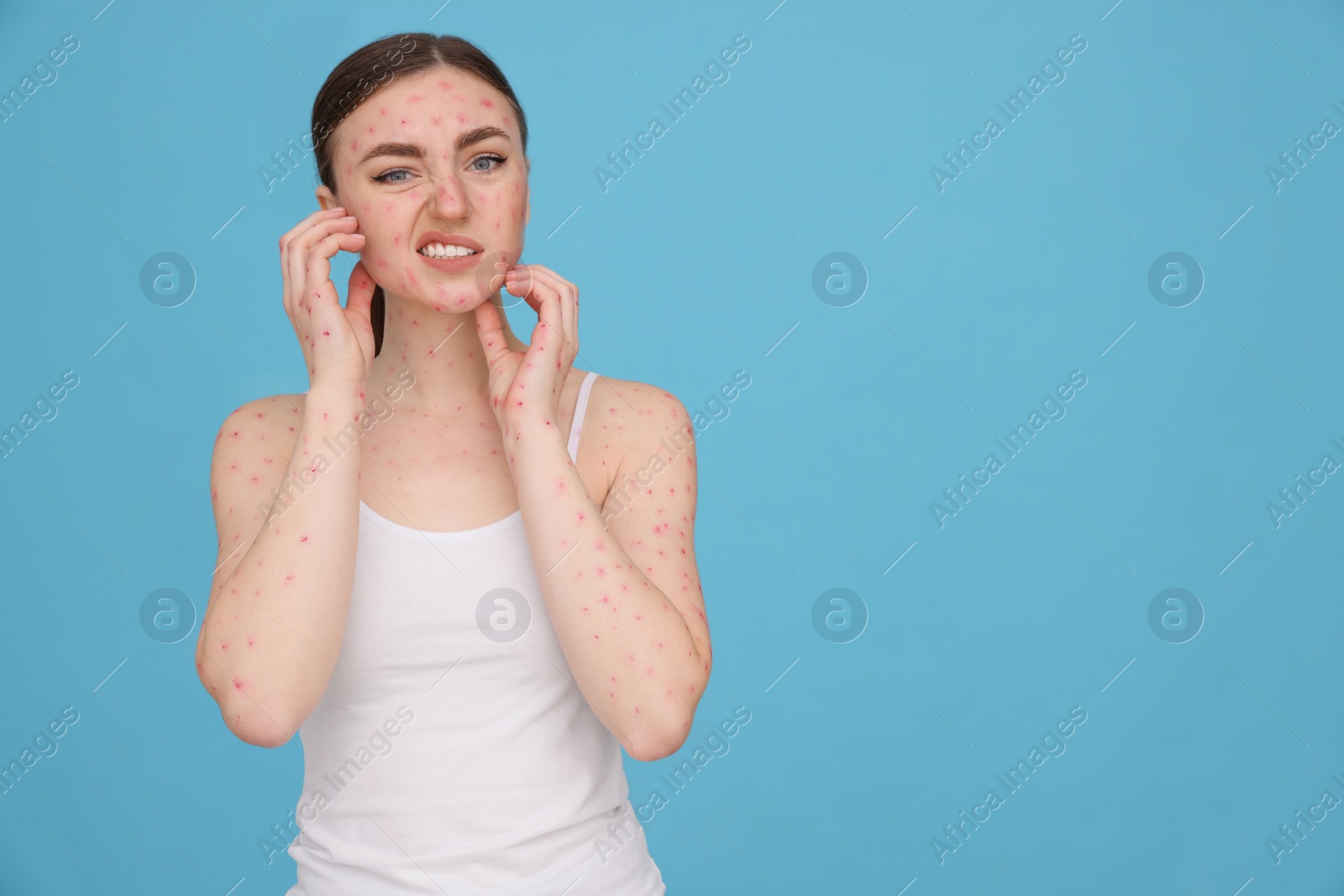 Photo of Woman with rash suffering from monkeypox virus on light blue background. Space for text