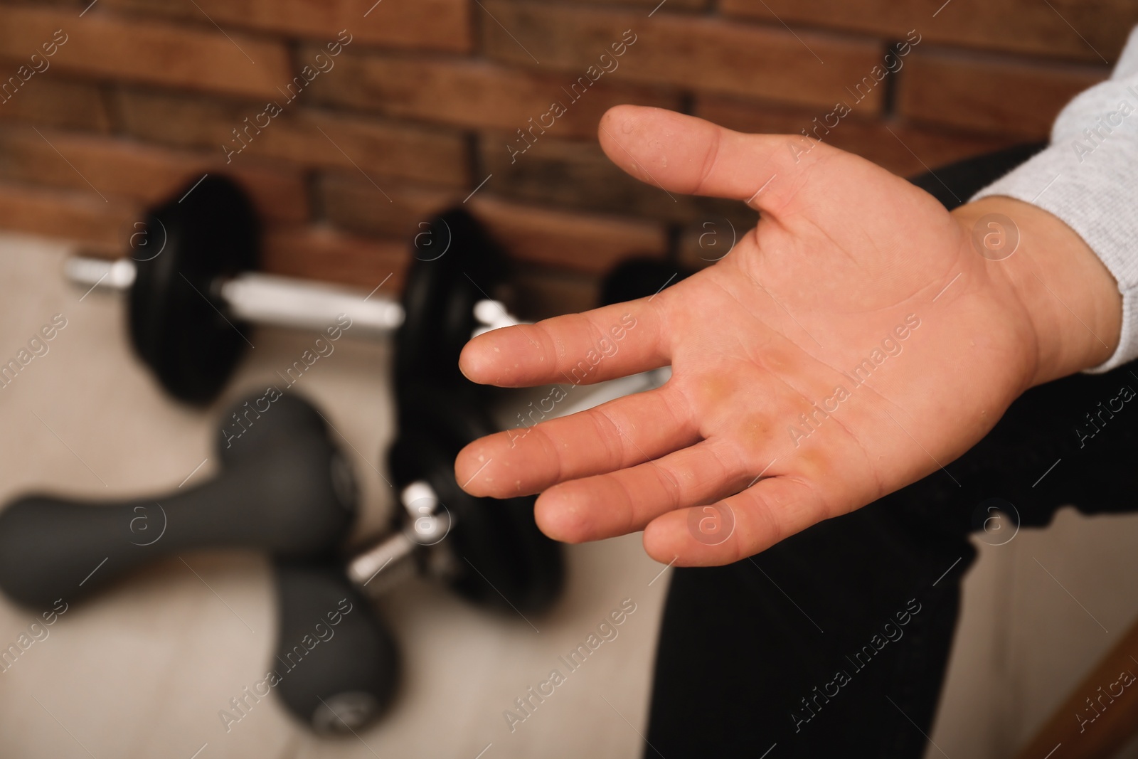 Photo of Man suffering from calluses on hand indoors, closeup