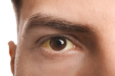 Photo of Man with yellow eyes on white background, closeup. Liver problems symptom