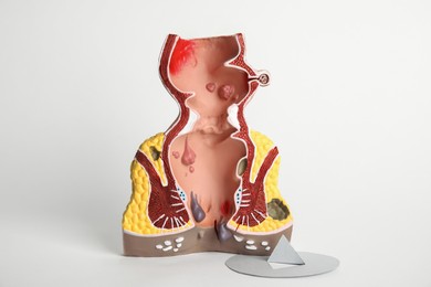 Photo of Model of unhealthy lower rectum with inflamed vascular structures and pin on light background. Hemorrhoid problem