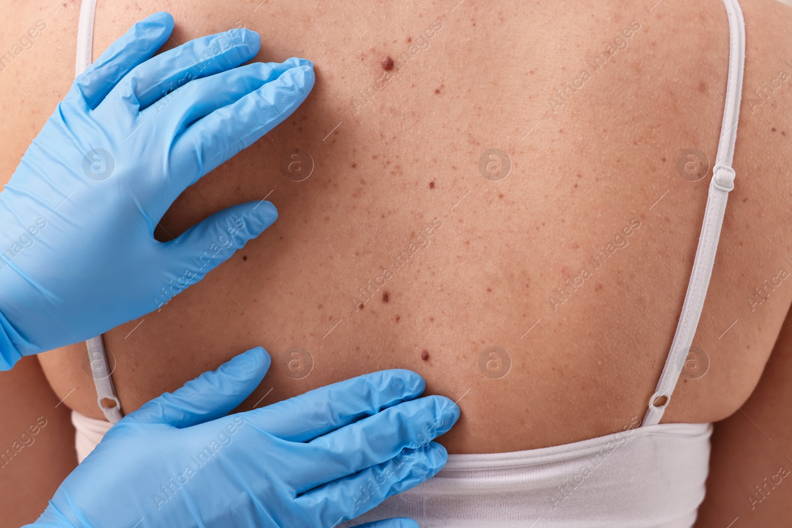 Photo of Dermatologist in rubber gloves examining patient's birthmark, closeup view