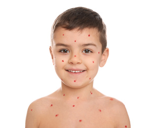 Little boy with chickenpox on white background