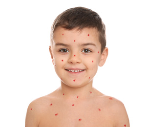 Photo of Little boy with chickenpox on white background