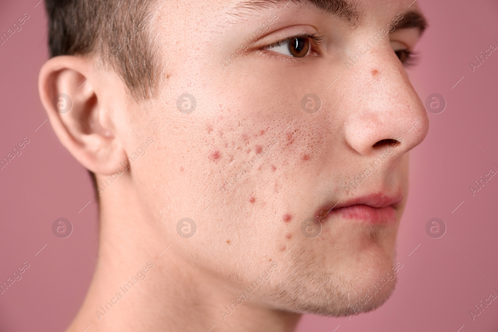 Photo of Young man with acne problem on color background