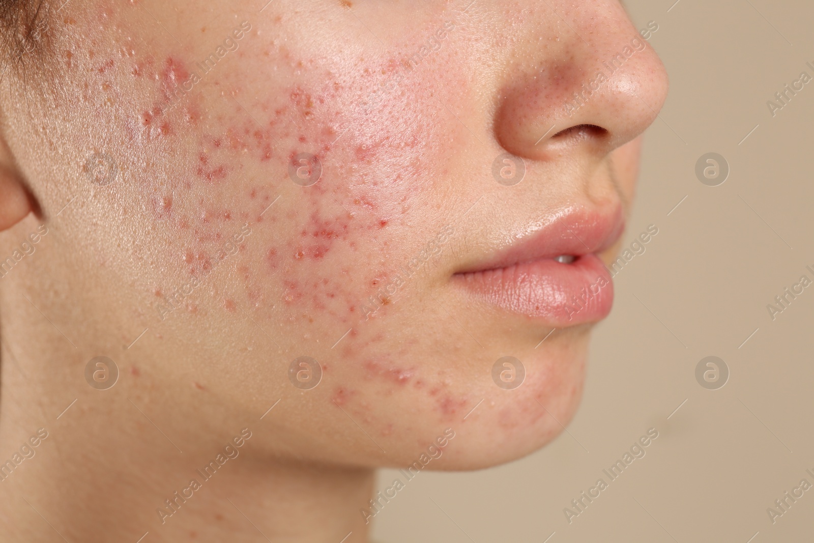 Photo of Teenage girl with acne problem on beige background, closeup