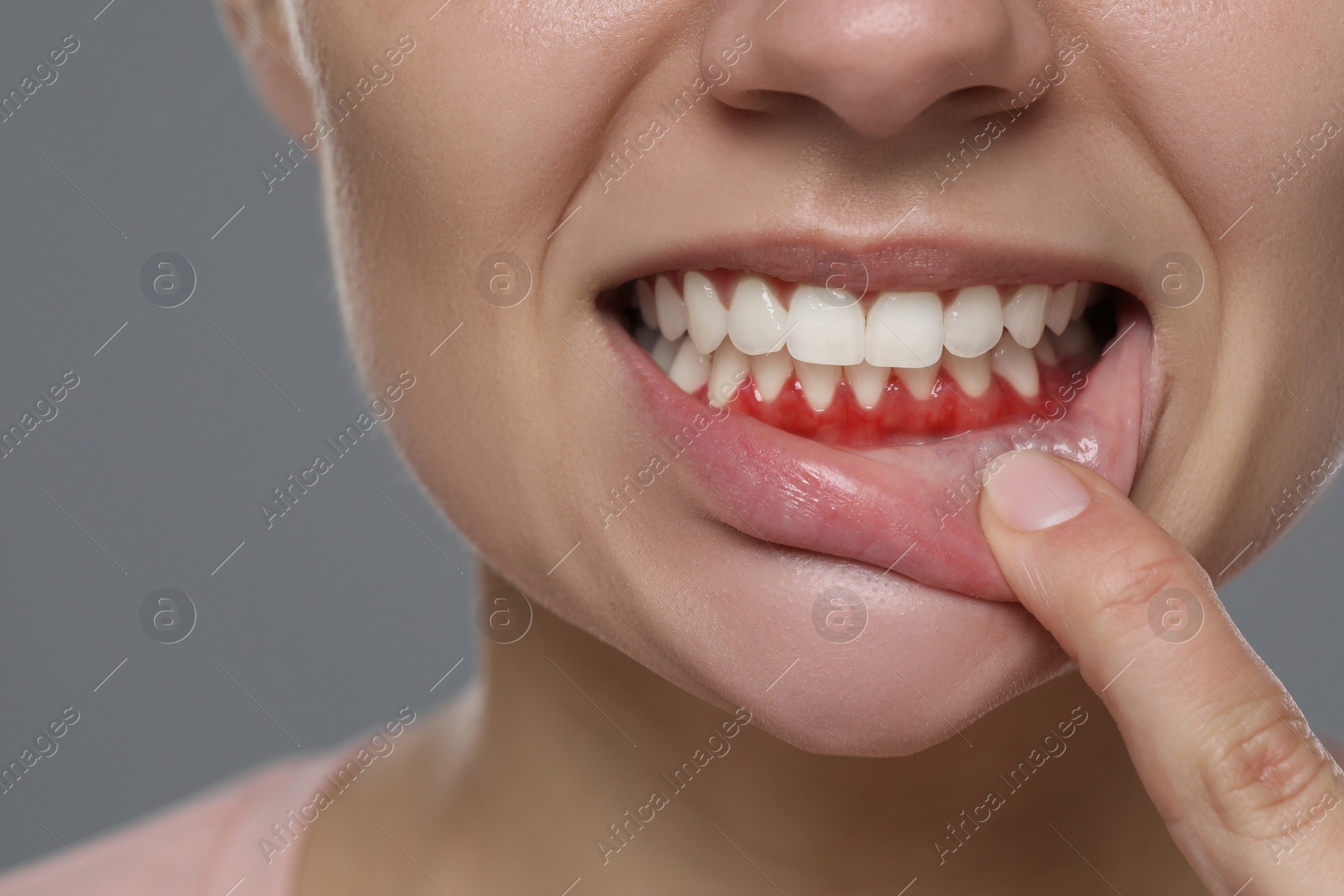 Image of Woman showing inflamed gum on grey background, closeup