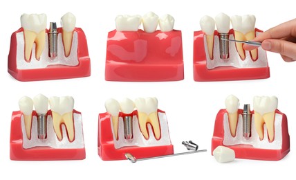 Educational models of gum with dental implant between teeth on white background, collage
