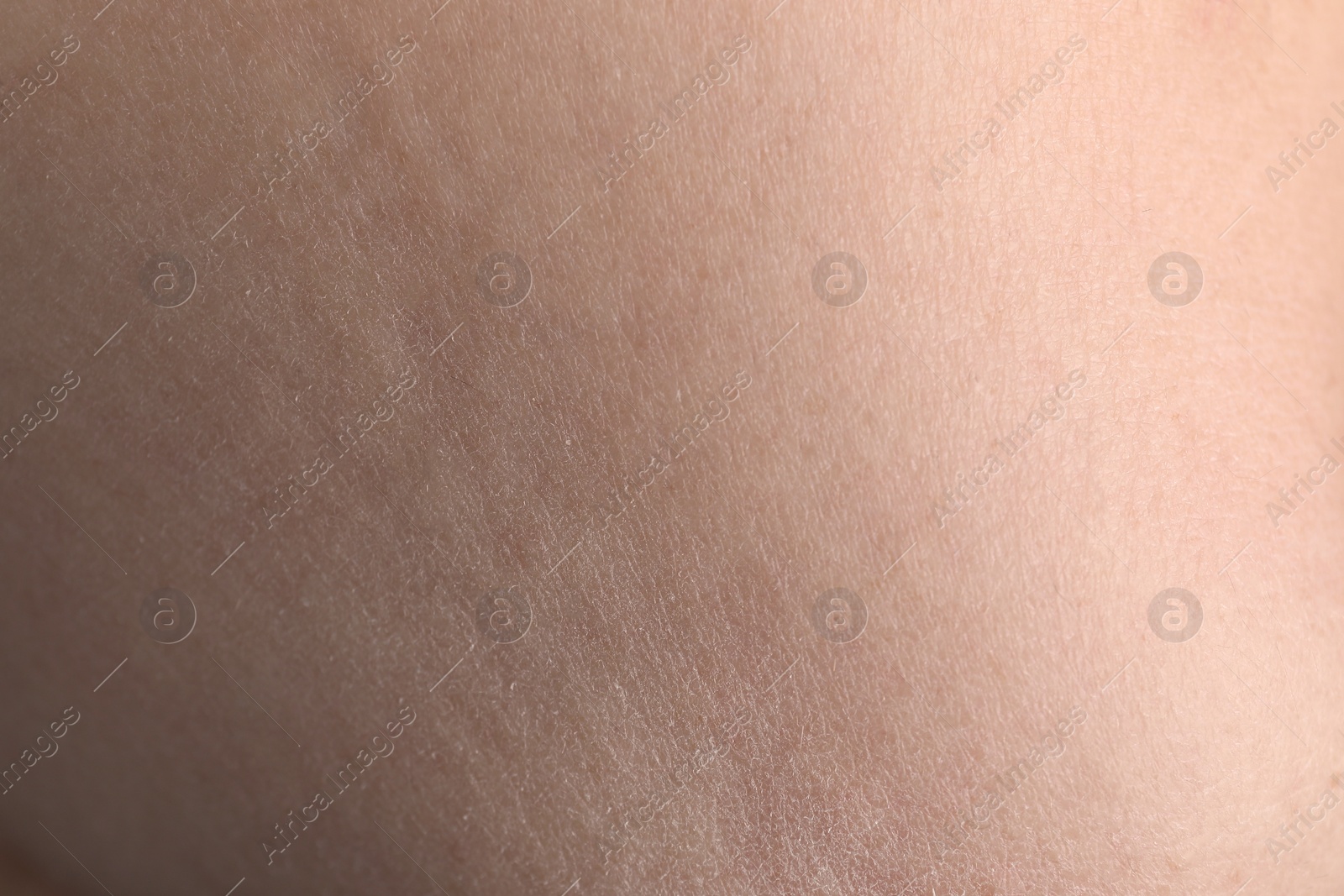 Photo of Closeup view of woman with dry skin