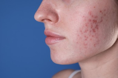 Young woman with acne problem on blue background, closeup. Space for text