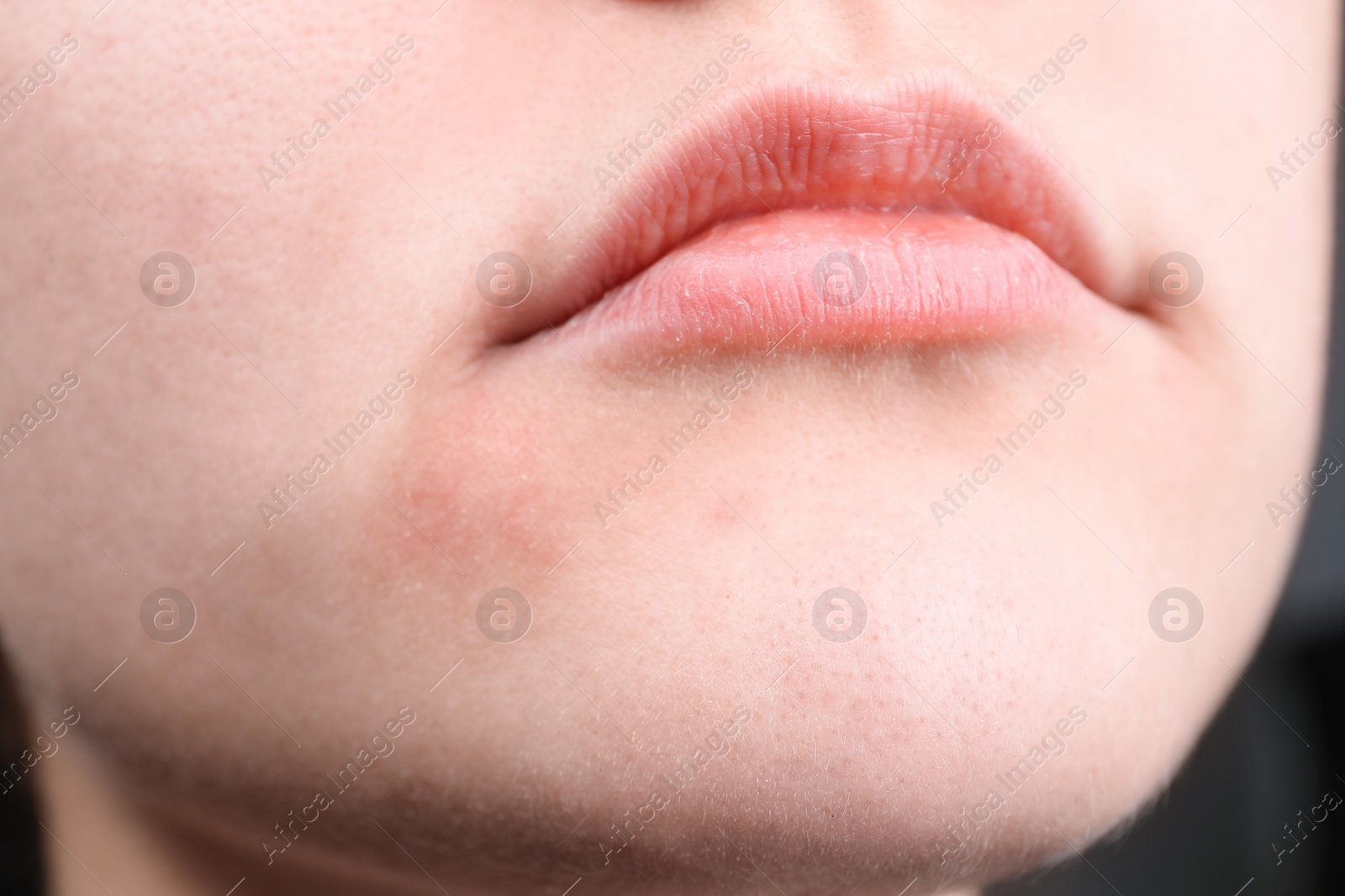 Photo of Woman with dry skin on face, closeup