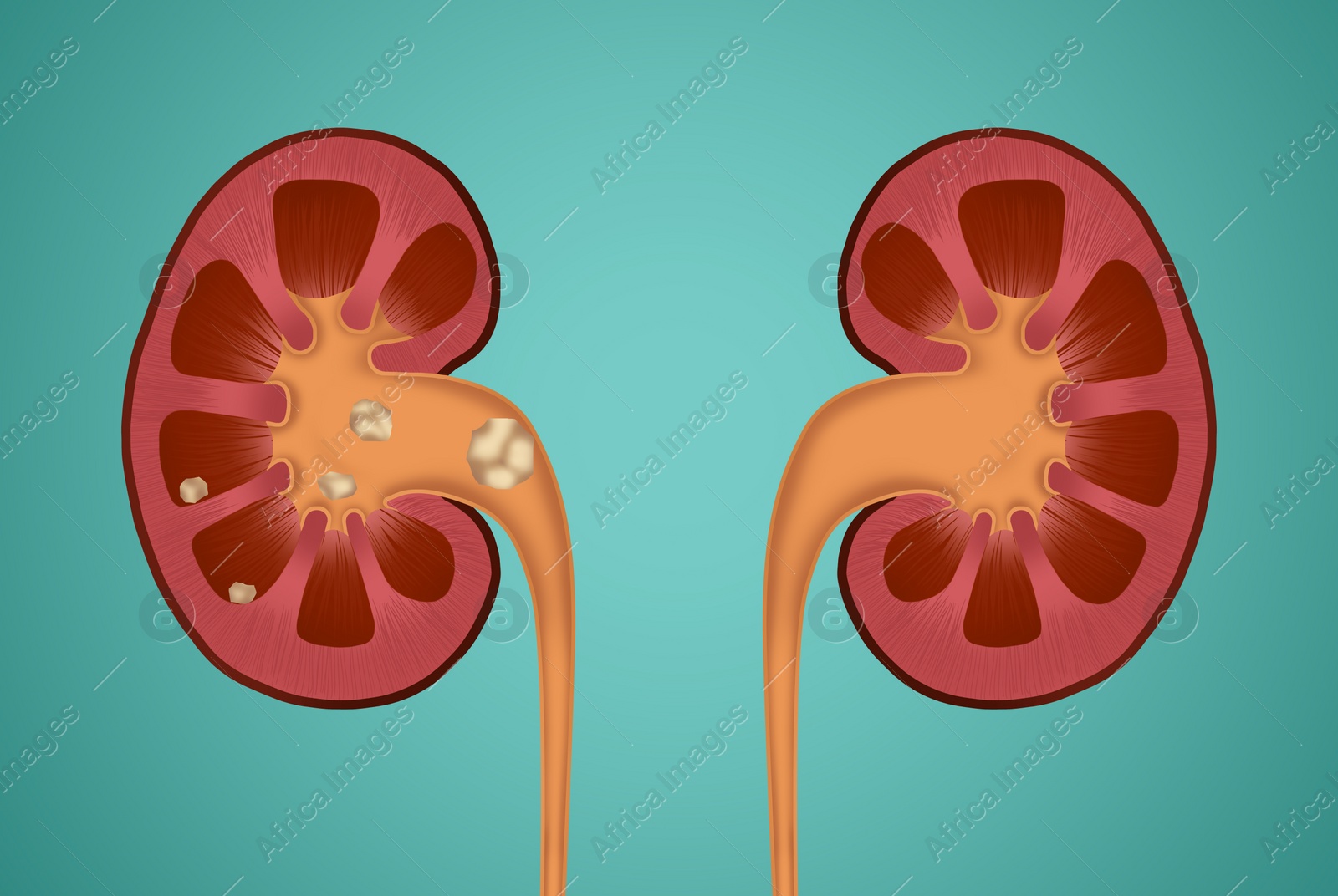 Illustration of  human kidneys, one with stones on blue background