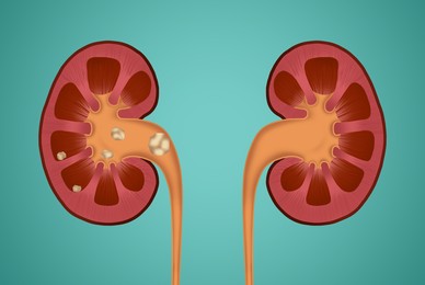 Illustration of  human kidneys, one with stones on blue background