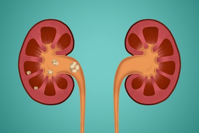 Illustration of human kidneys, one with stones on blue background