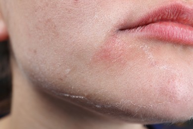 Woman with dry skin on face, closeup