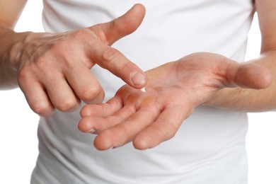 Man applying cream on hand for calluses treatment against white background, closeup