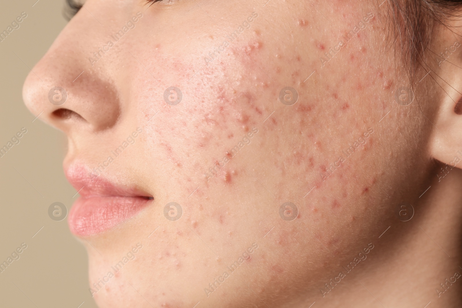 Photo of Teenage girl with acne problem on beige background, closeup