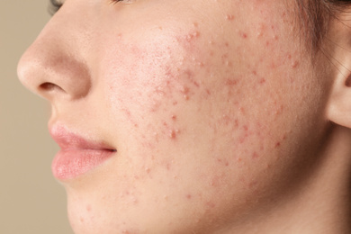 Photo of Teenage girl with acne problem on beige background, closeup