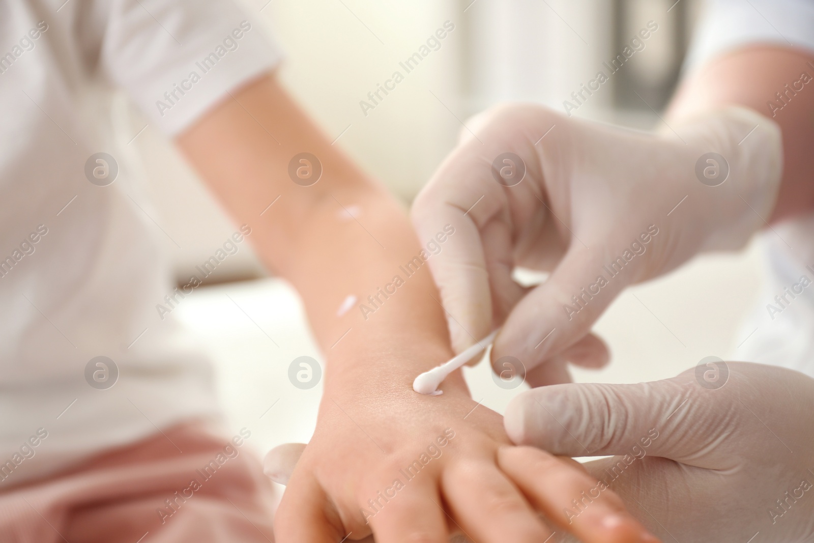 Photo of Doctor applying cream onto skin of little girl with chickenpox in clinic, closeup. Varicella zoster virus