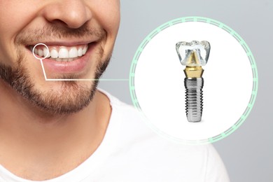 Image of Man with beautiful smile after dental implant installation procedure on grey background, closeup