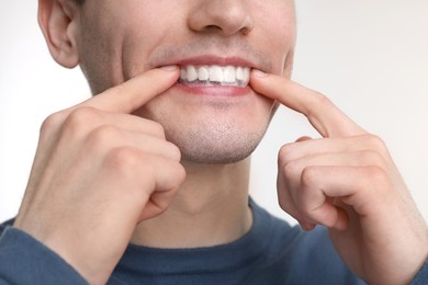 Young man applying whitening strip on his teeth against light background, closeup