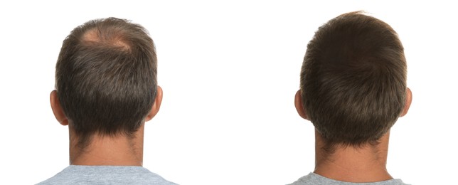 Image of Man before and after hair treatment with high frequency darsonval device on white background, back view. Collage of photos