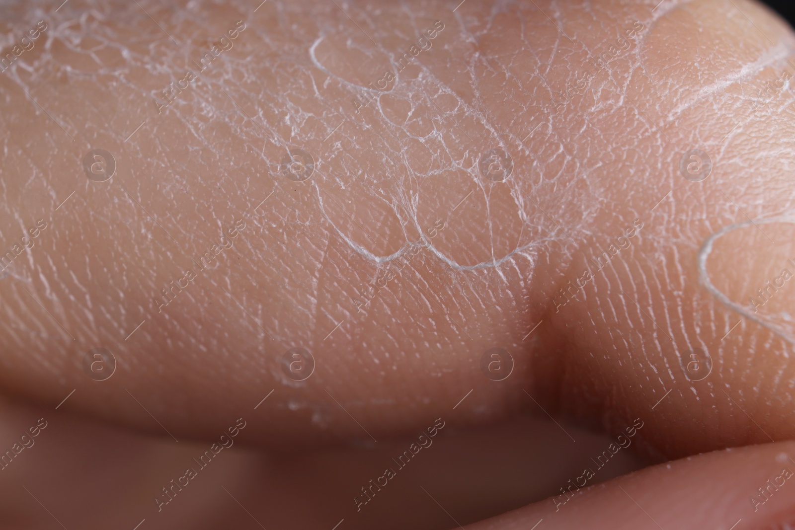 Photo of Woman with dry skin on hand, macro view