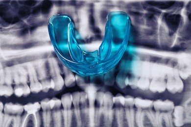 Photo of Mouth guard on dental scan, top view. Bite correction