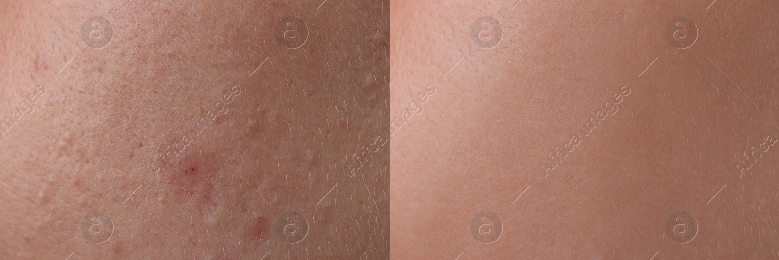 Image of Collage with photos of person suffering from acne before and after treatment, closeup. Banner design showing affected and healthy skin