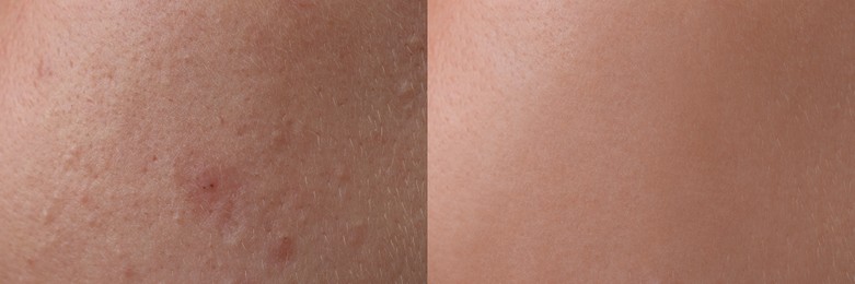 Collage with photos of person suffering from acne before and after treatment, closeup. Banner design showing affected and healthy skin