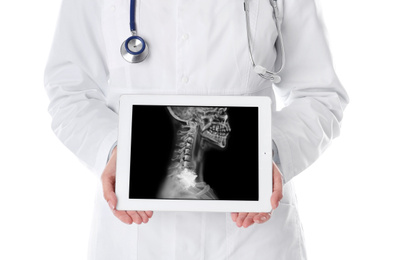 Image of Doctor showing x-ray of patient with cancer on tablet against white background, closeup