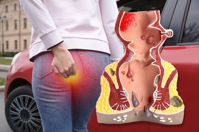 Image of Anatomical model of rectum with hemorrhoids. Woman suffering from pain outdoors, closeup