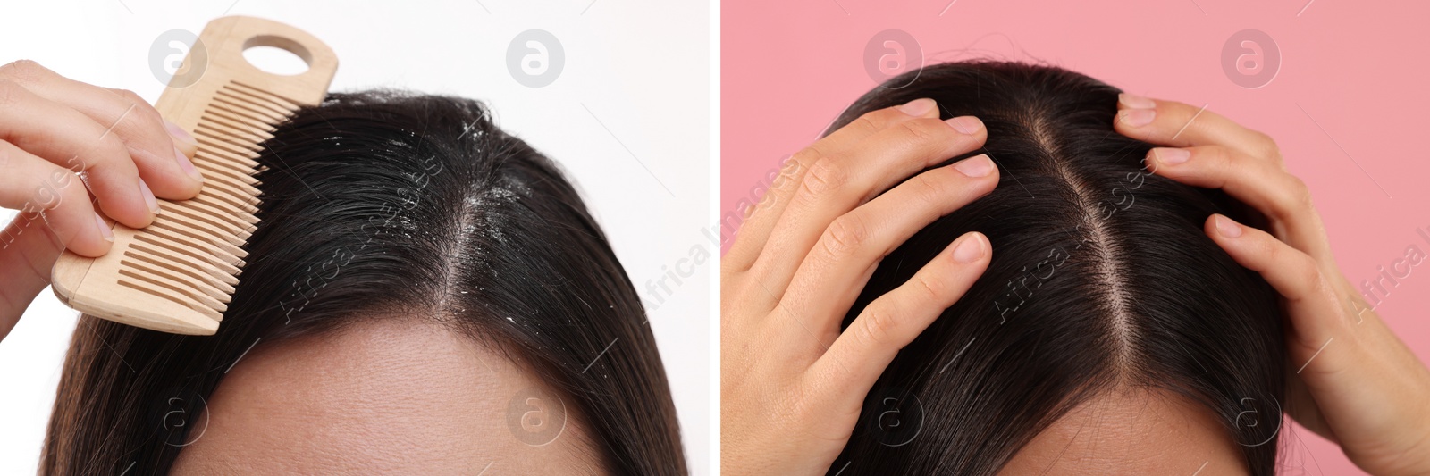 Image of Woman showing hair before and after dandruff treatment on color backgrounds, collage