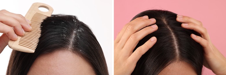 Woman showing hair before and after dandruff treatment on color backgrounds, collage