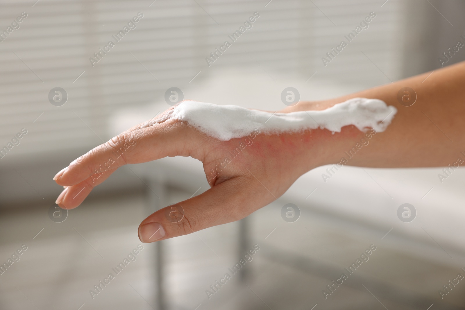 Photo of Woman with panthenol on her burned hand indoors, closeup