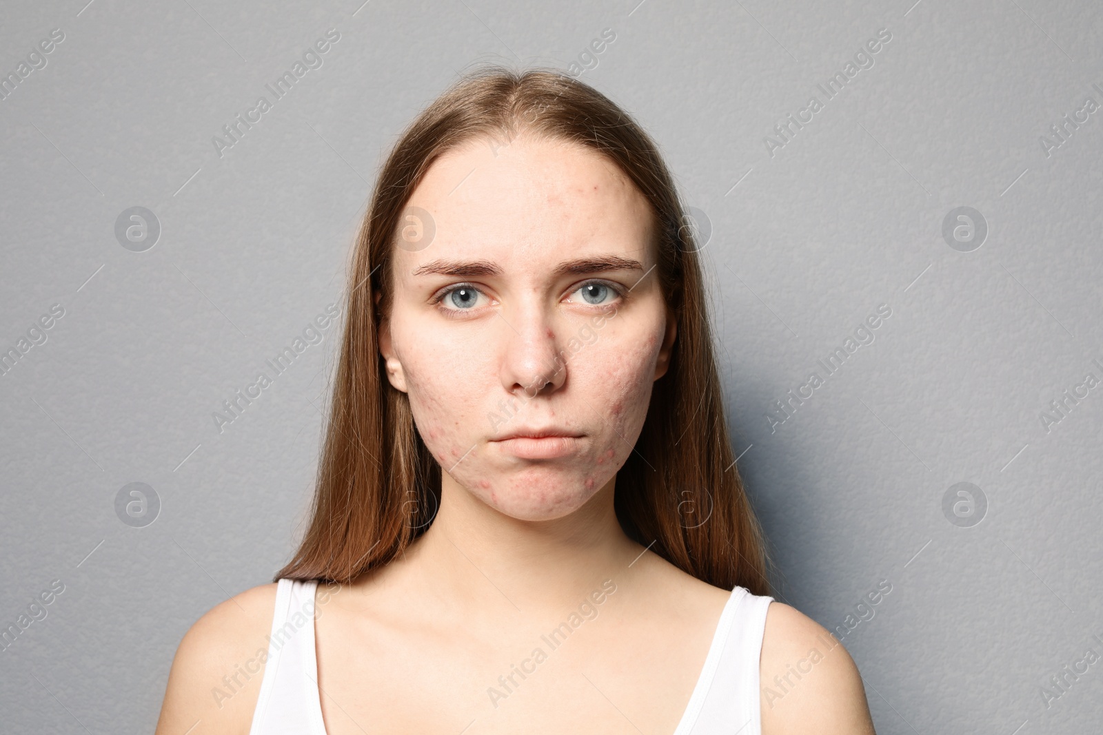 Photo of Young woman with acne problem on color background