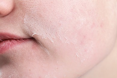 Woman with dry skin on face, closeup