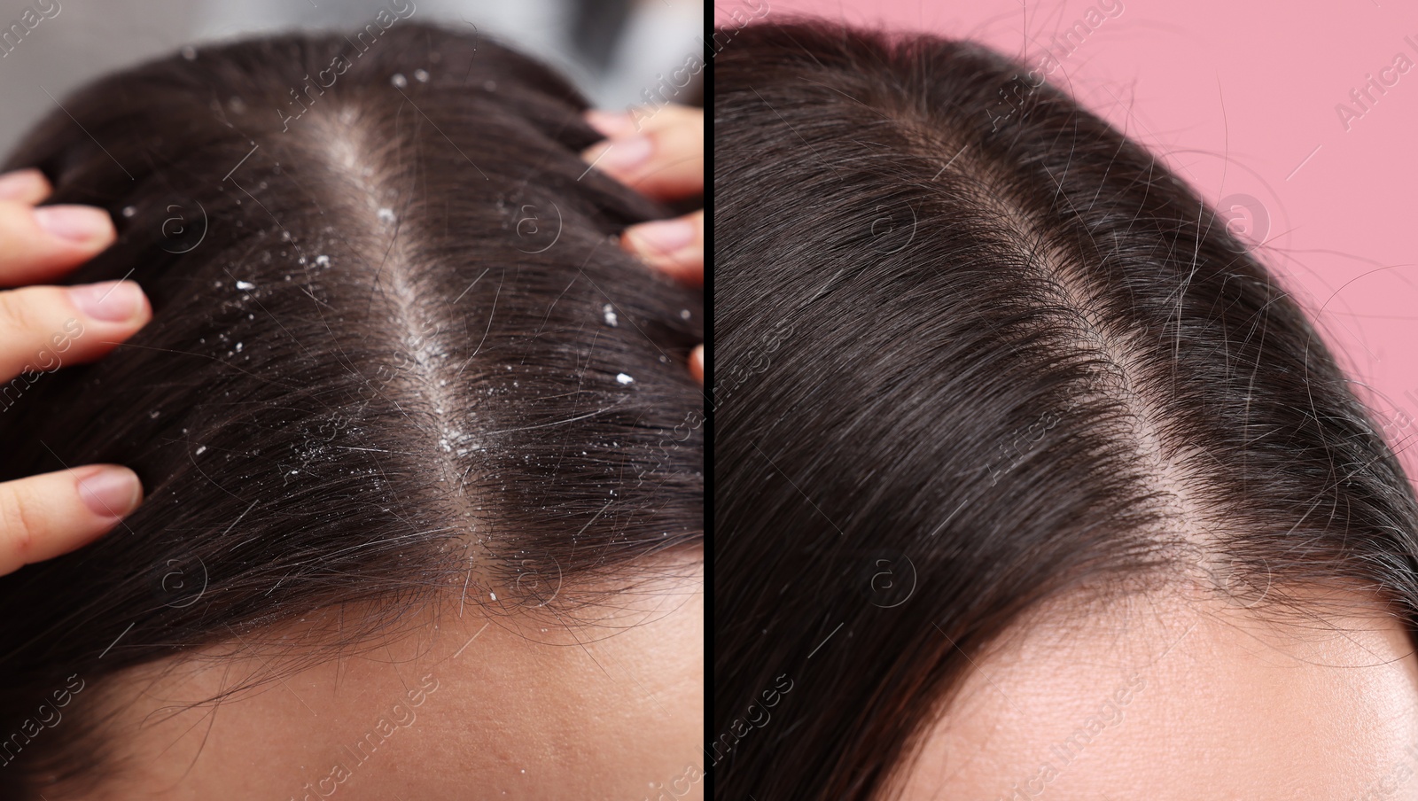 Image of Woman showing hair before and after dandruff treatment, collage