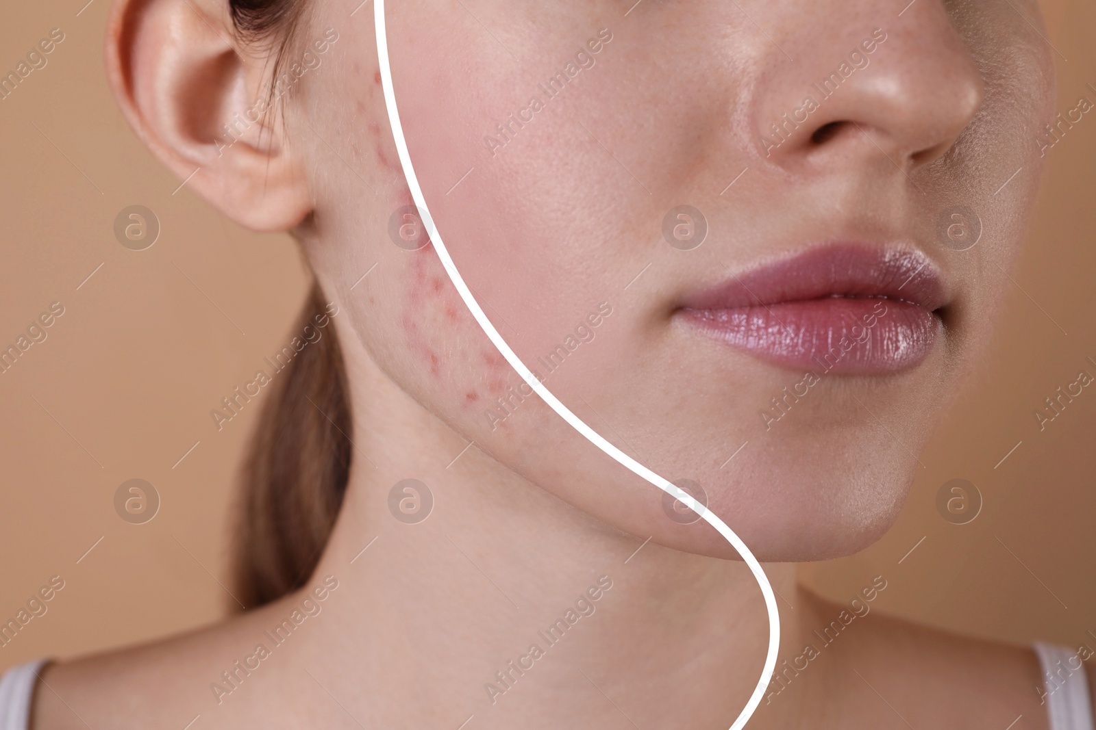 Image of Acne problem, collage. Photo of woman divided into halves before and after treatment on beige background, closeup