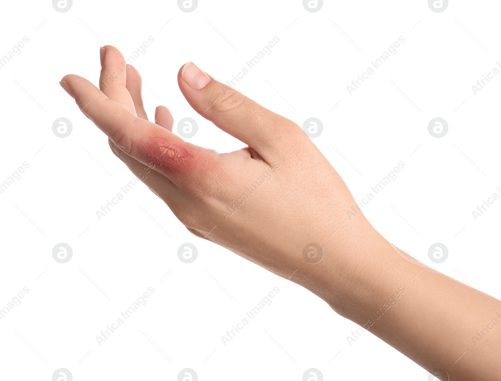 Photo of Woman with burn of her hand on white background, closeup