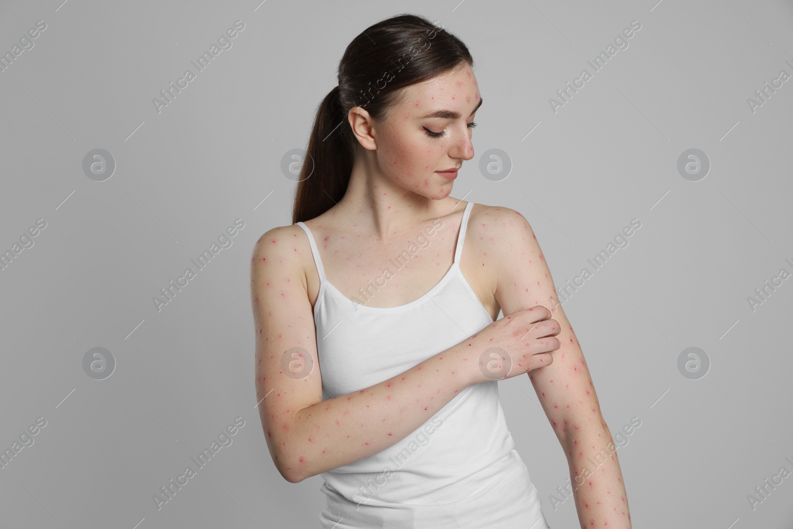 Photo of Woman with rash suffering from monkeypox virus on light grey background