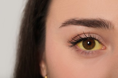 Woman with yellow eyes on light background, closeup. Symptom of hepatitis