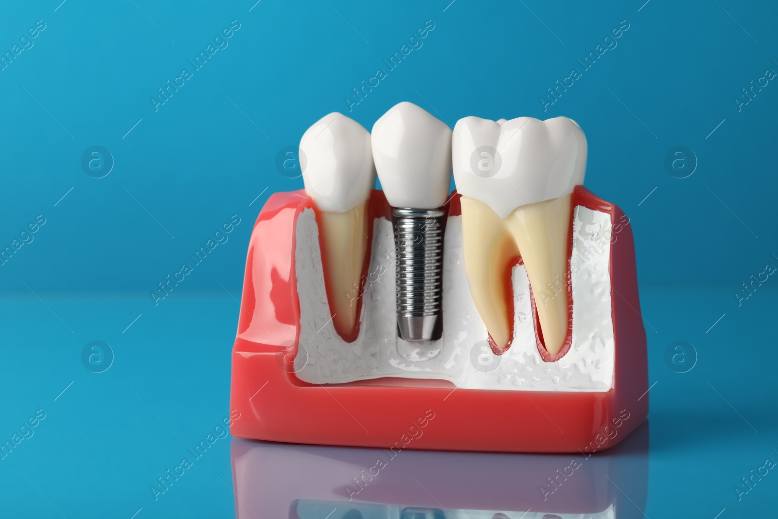 Photo of Educational model of gum with dental implant between teeth on light blue background