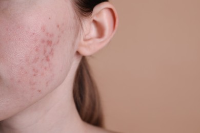 Young woman with acne problem on beige background, closeup. Space for text