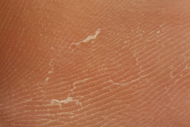 Photo of Texture of dry skin as background, macro view