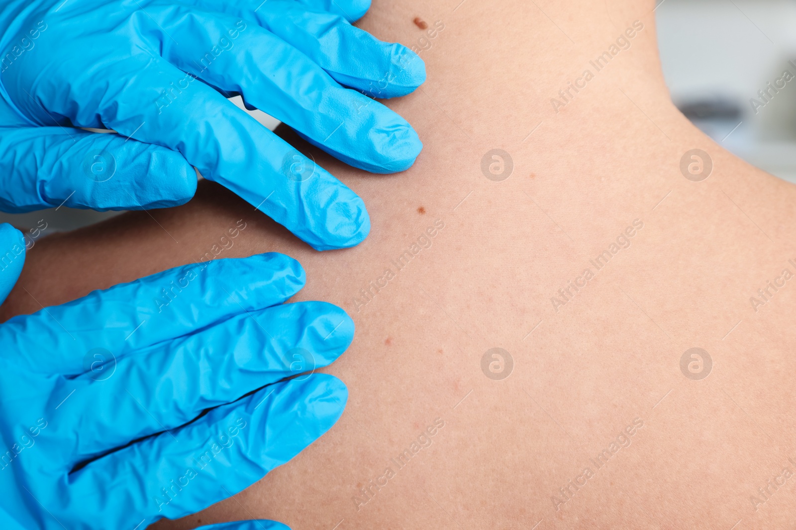 Photo of Dermatologist examining patient's birthmark in clinic, closeup