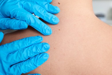 Dermatologist examining patient's birthmark in clinic, closeup