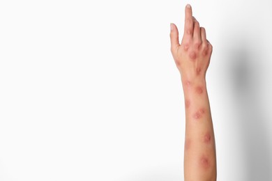 Woman with rash suffering from monkeypox virus on white background, closeup. Space for text