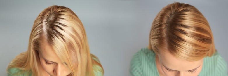 Image of Woman before and after hair treatment with high frequency darsonval device on grey background, closeup. Collage of photos