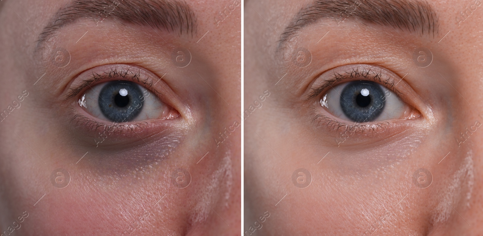 Image of Collage with photos of woman with dark circle under eye before and after treatment, closeup