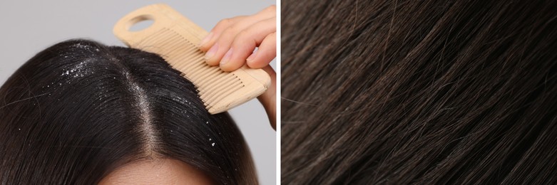 Image of Woman showing hair before and after dandruff treatment, collage